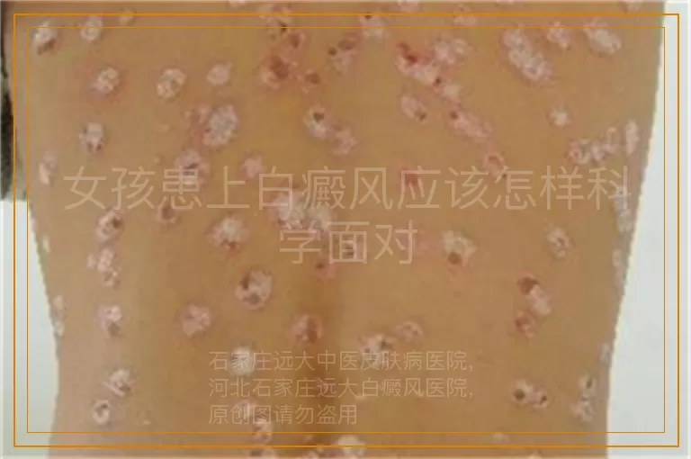 女孩患上白癜风应该怎样科学面对