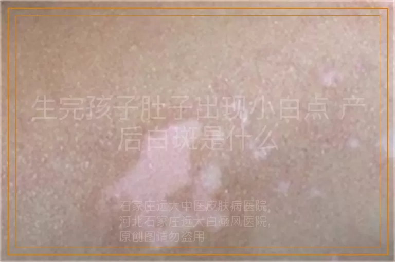 生完孩子肚子出现小白点 产后白斑是什么
