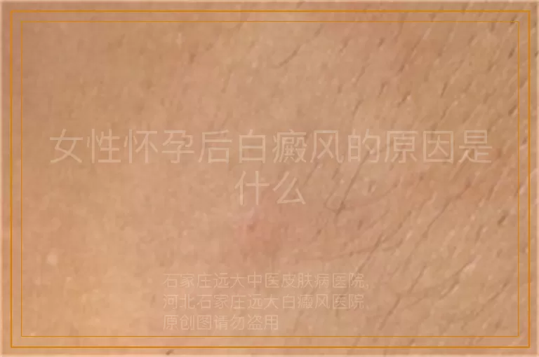 女性怀孕后白癜风的原因是什么