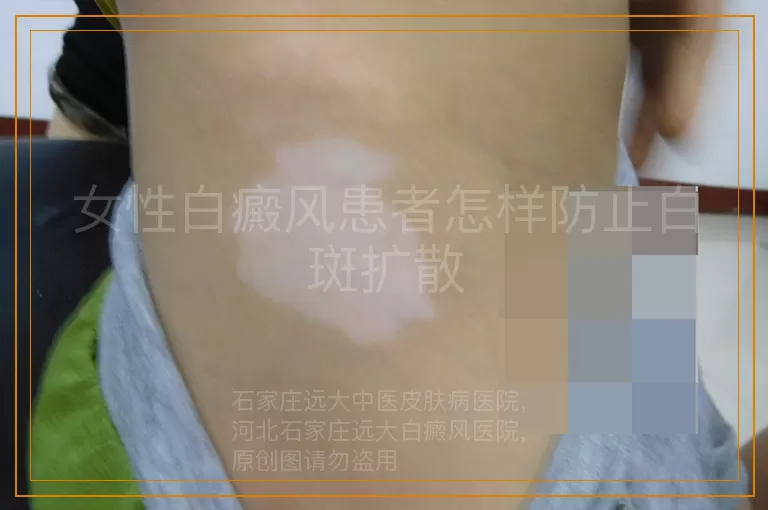 女性白癜风患者怎样防止白斑扩散