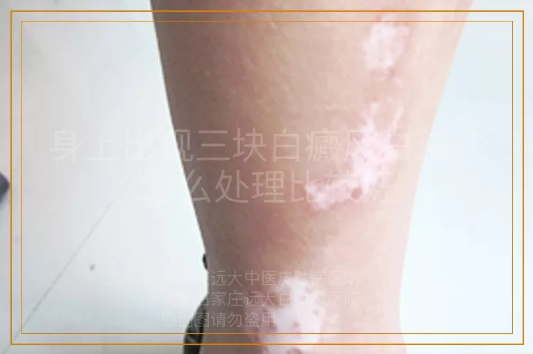 身上出现三块白癜风白斑该怎么处理比较好