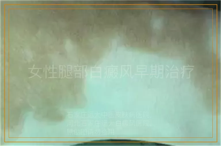 女性腿部白癜风早期治疗