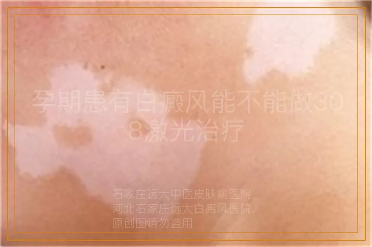 孕期患有白癜风能不能做308激光治疗