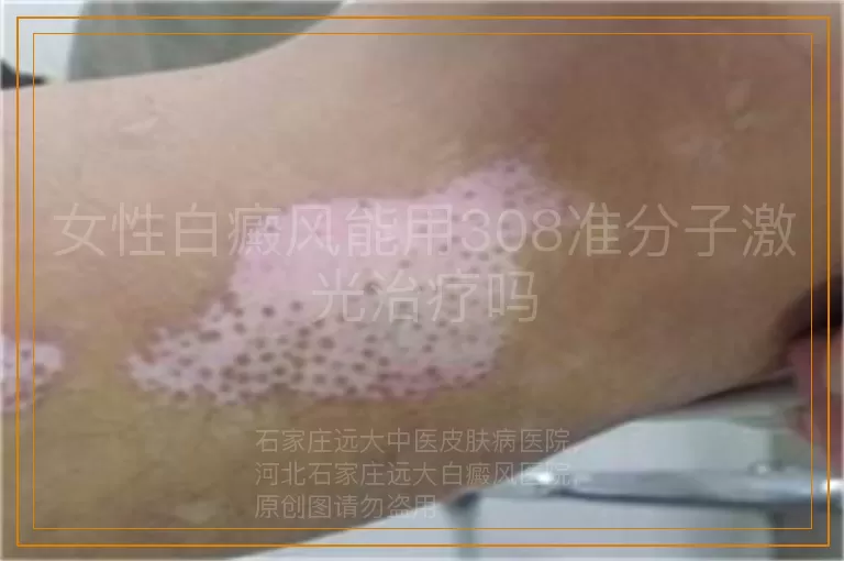 女性白癜风能用308准分子激光治疗吗