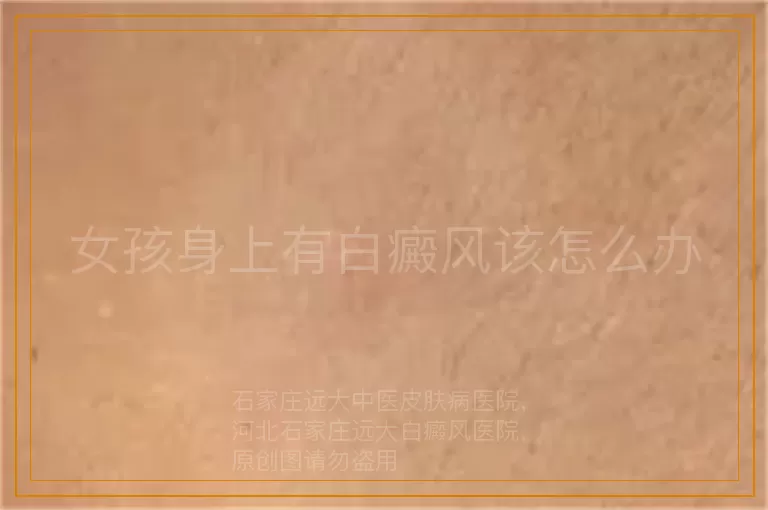 女孩身上有白癜风该怎么办