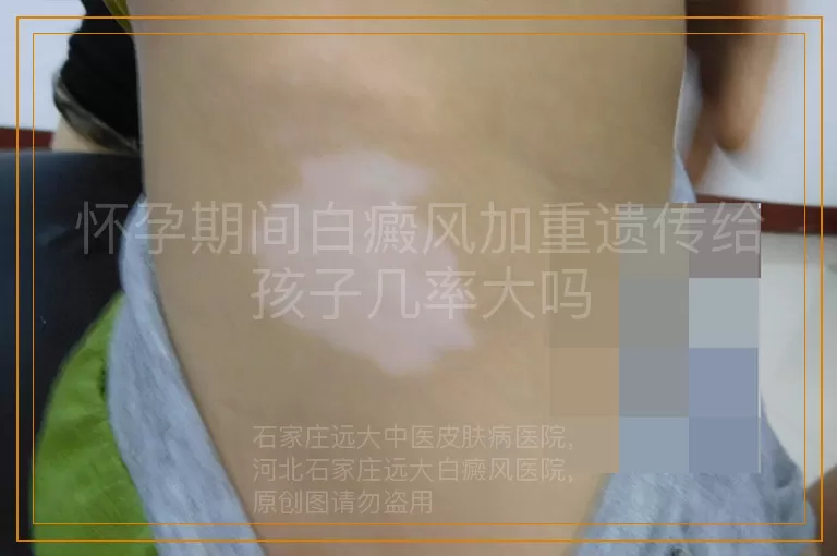怀孕期间白癜风加重遗传给孩子几率大吗