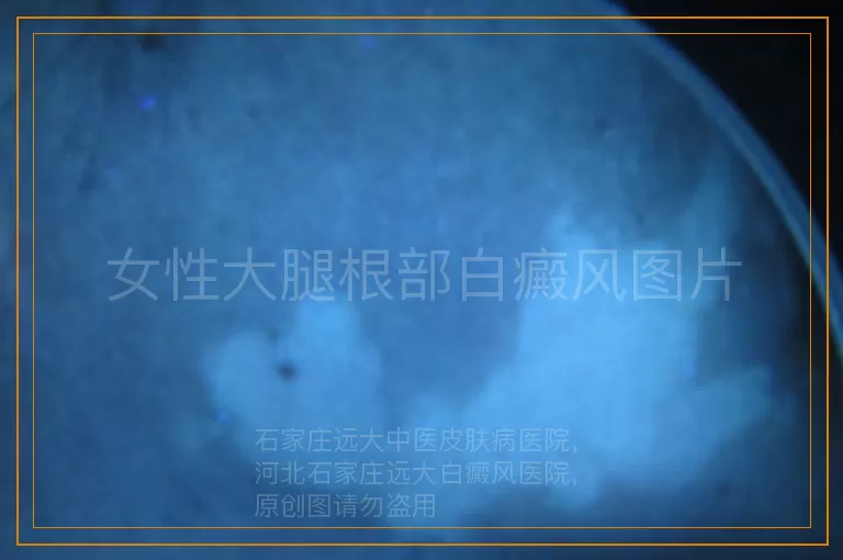 女性大腿根部白癜风图片