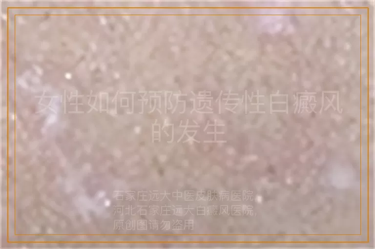 女性如何预防遗传性白癜风的发生