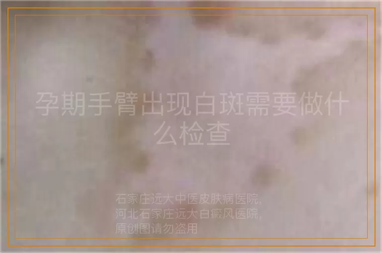 孕期手臂出现白斑需要做什么检查