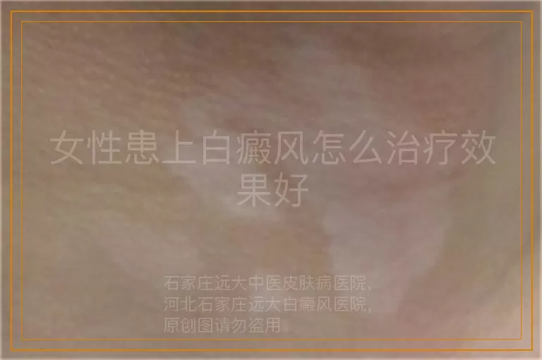 女性患上白癜风怎么治疗效果好