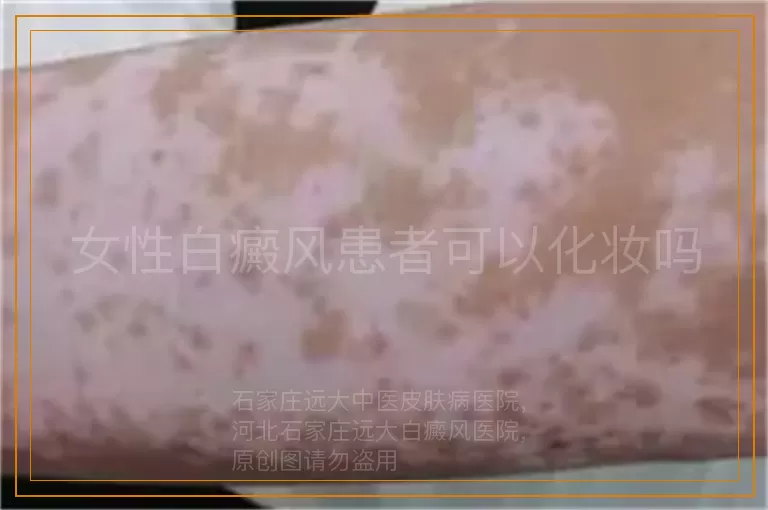 女性白癜风患者可以化妆吗