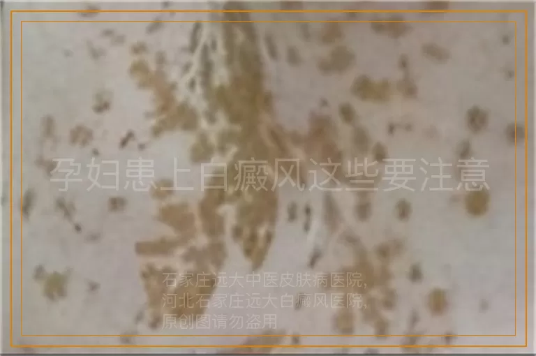 孕妇患上白癜风这些要注意