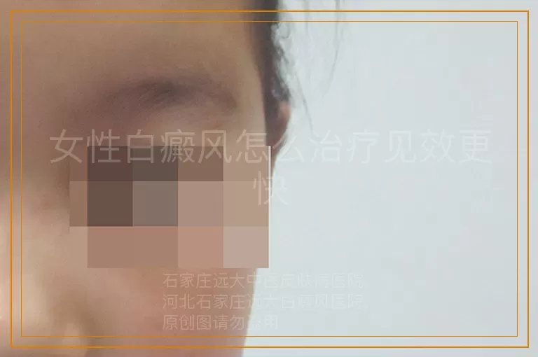 女性白癜风怎么治疗见效更快