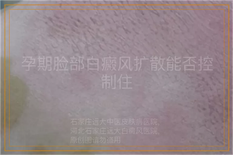 孕期脸部白癜风扩散能否控制住