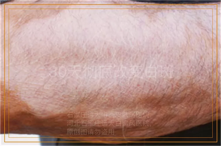 30天彻底改变白斑
