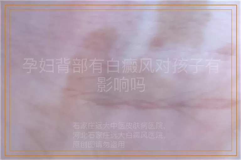 孕妇背部有白癜风对孩子有影响吗