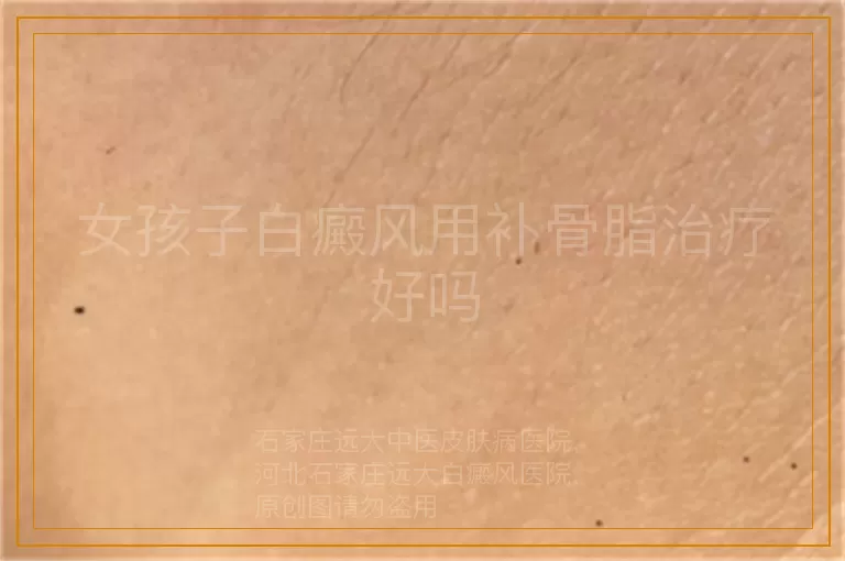 女孩子白癜风用补骨脂治疗好吗