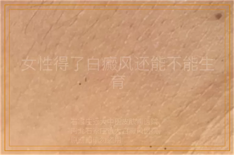 女性得了白癜风还能不能生育