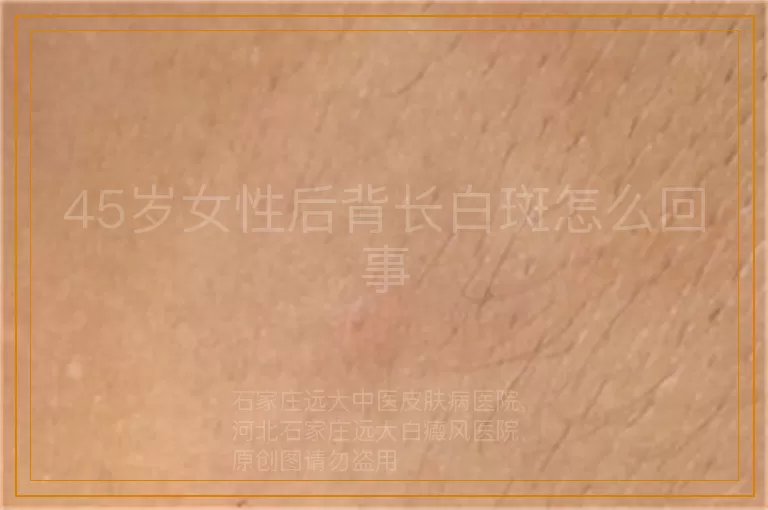45岁女性后背长白斑怎么回事