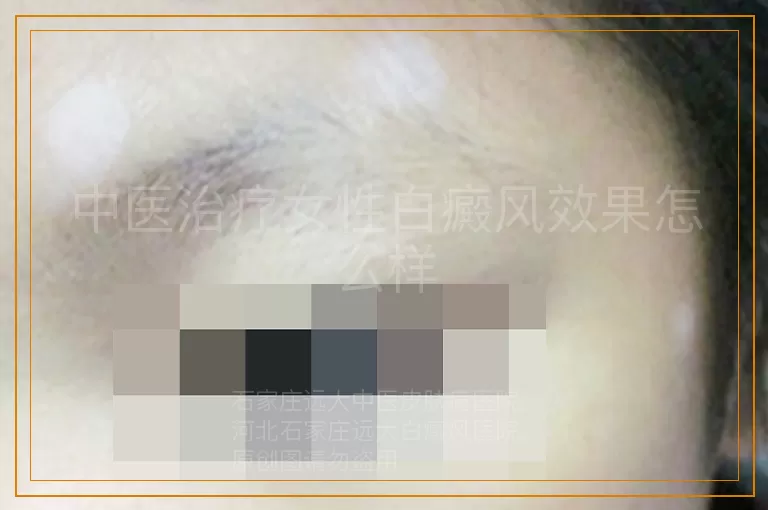 中医治疗女性白癜风效果怎么样