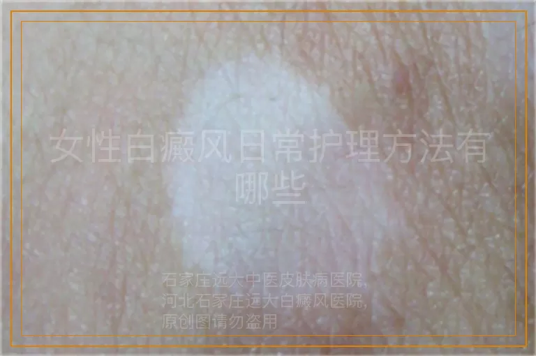 女性白癜风日常护理方法有哪些