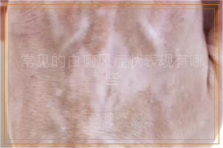 常见的白癜风症状表现有哪些