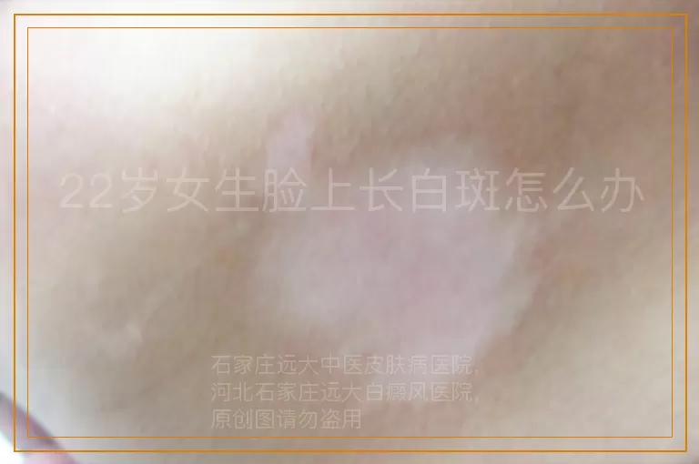 22岁女生脸上长白斑怎么办