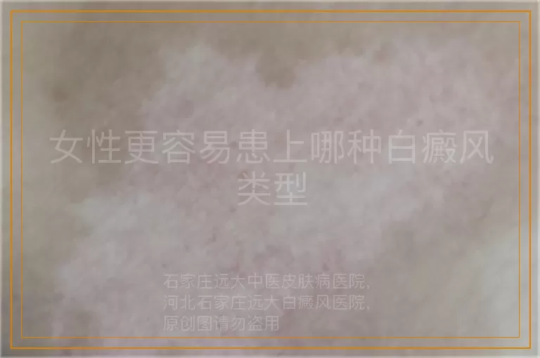 女性更容易患上哪种白癜风类型