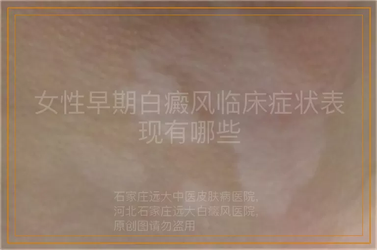 女性早期白癜风临床症状表现有哪些