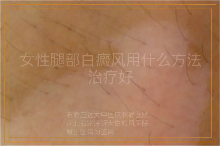 女性腿部白癜风用什么方法治疗好