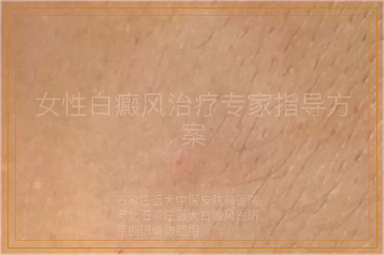女性白癜风治疗专家指导方案