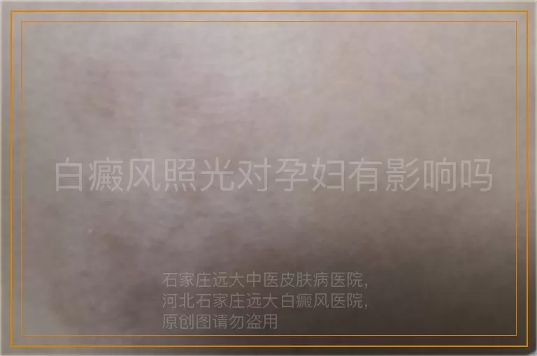 白癜风照光对孕妇有影响吗