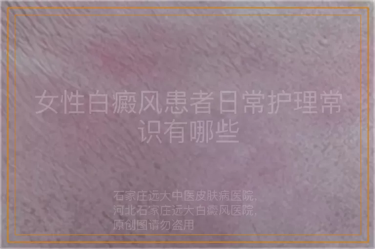 女性白癜风患者日常护理常识有哪些