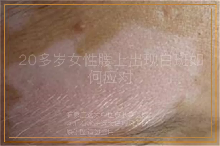 20多岁女性腰上出现白斑如何应对