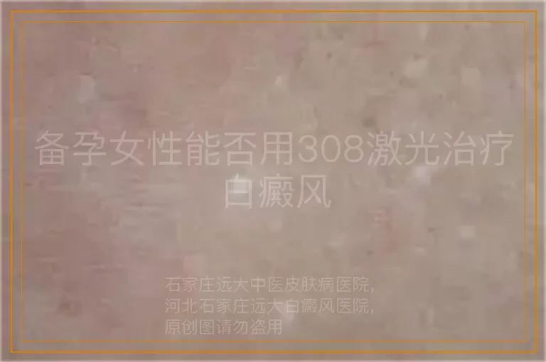 备孕女性能否用308激光治疗白癜风