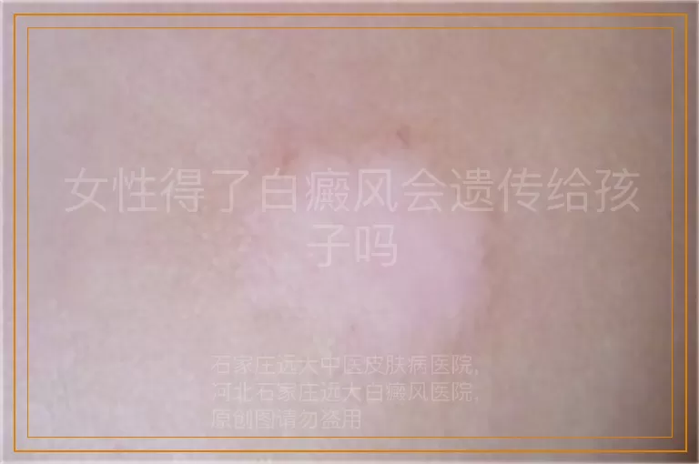 女性得了白癜风会遗传给孩子吗