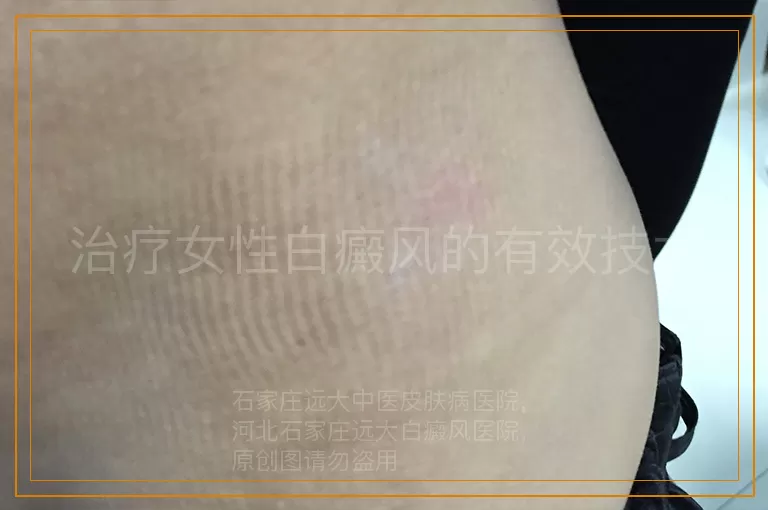 治疗女性白癜风的有效技术