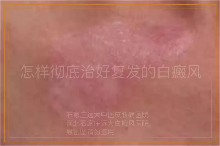 怎样彻底治好复发的白癜风