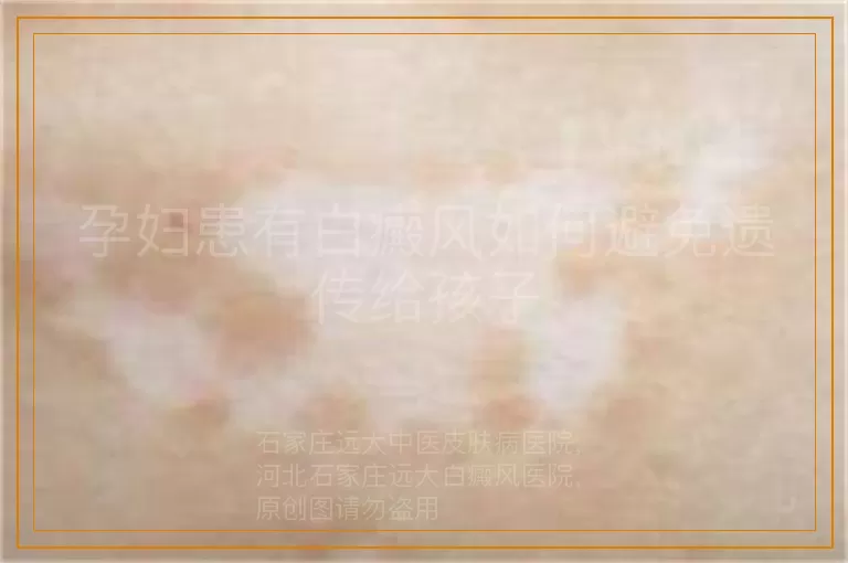 孕妇患有白癜风如何避免遗传给孩子