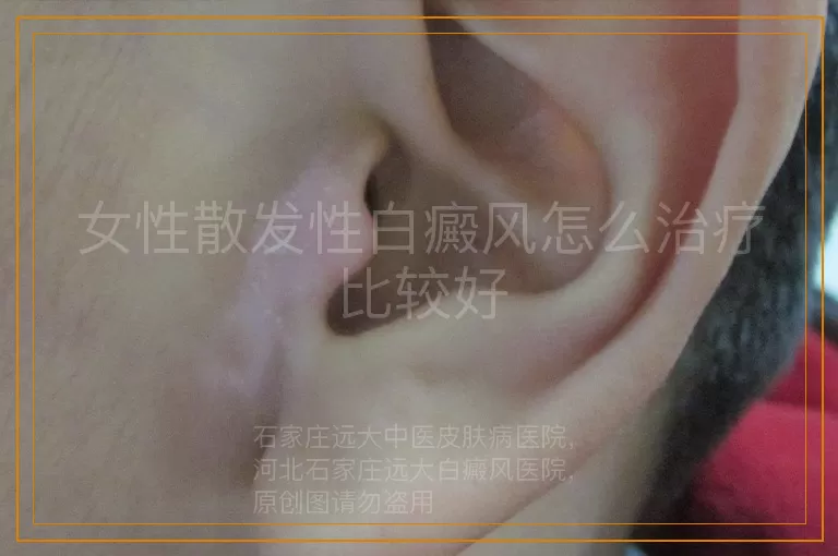女性散发性白癜风怎么治疗比较好