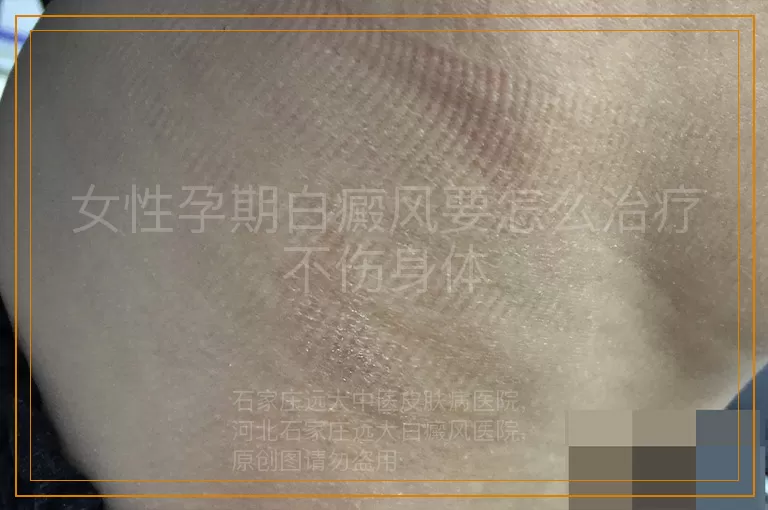 女性孕期白癜风要怎么治疗不伤身体