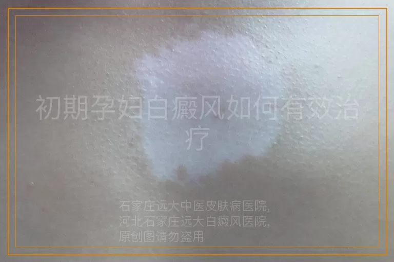 初期孕妇白癜风如何有效治疗