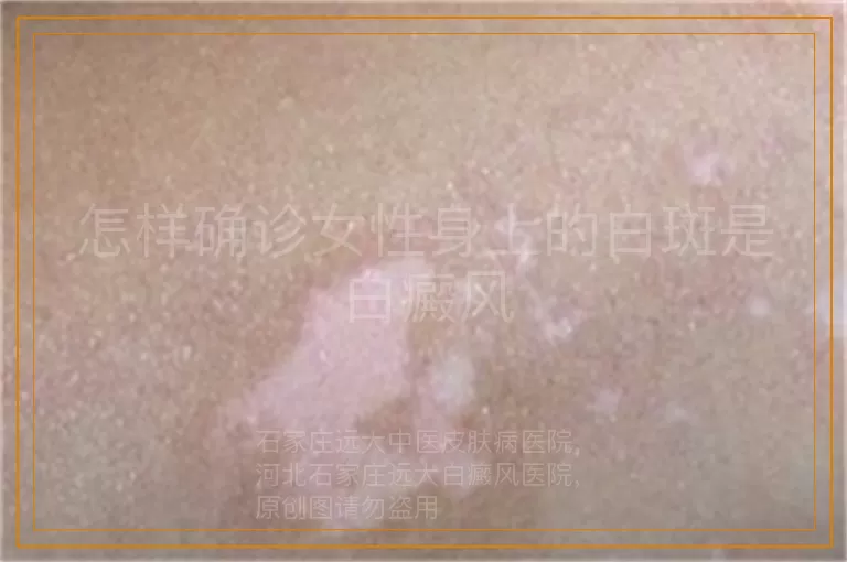 怎样确诊女性身上的白斑是白癜风