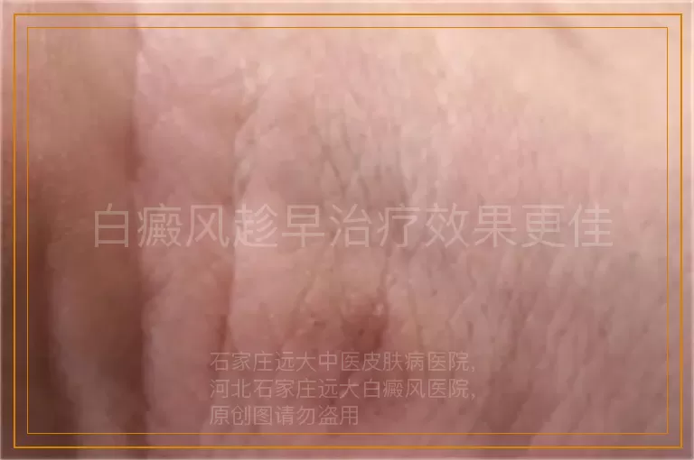 白癜风趁早治疗效果更佳