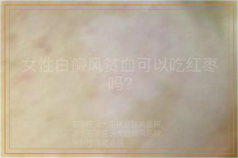 女性白癜风贫血可以吃红枣吗?