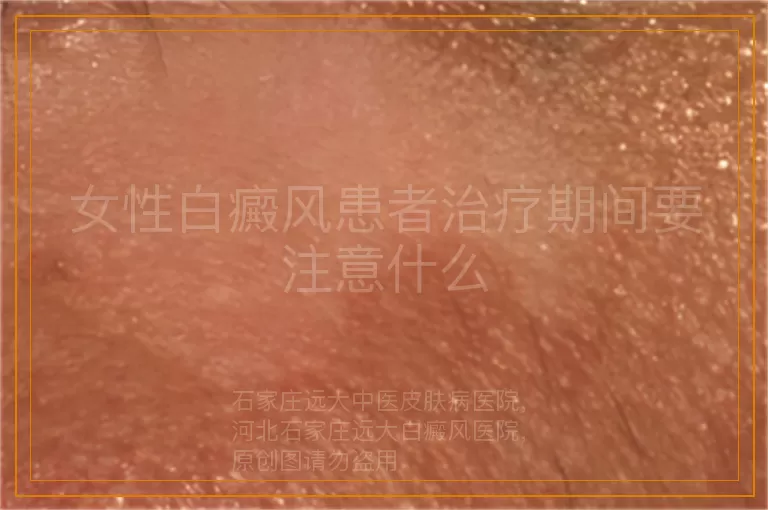女性白癜风患者治疗期间要注意什么