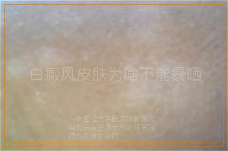白癜风皮肤为啥不能暴晒