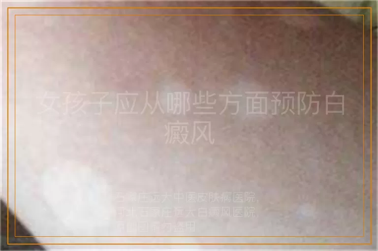 女孩子应从哪些方面预防白癜风