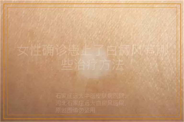 女性确诊患上了白癜风有哪些治疗方法