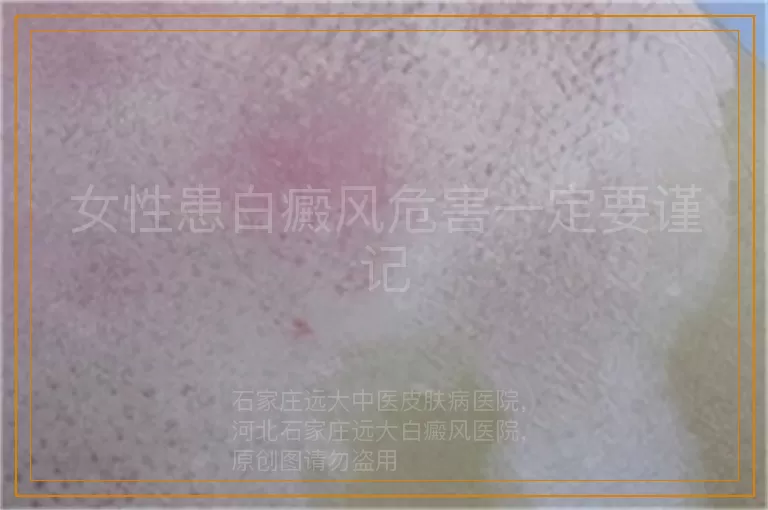 女性患白癜风危害一定要谨记
